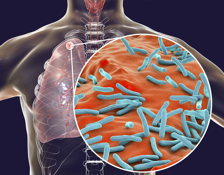 Tuberculosis Awareness